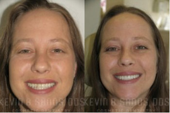 cosmetic-dentistry-beverly-hills-smile-gallery-02