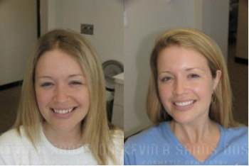 cosmetic-dentistry-beverly-hills-smile-gallery-02