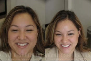 cosmetic-dentistry-beverly-hills-smile-gallery-01