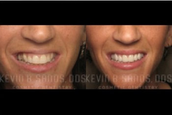 cosmetic-dentistry-beverly-hills-smile-gallery-02