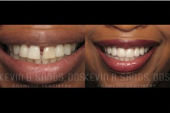 cosmetic-dentistry-beverly-hills-smile-gallery-01