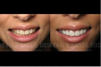cosmetic-dentistry-beverly-hills-smile-gallery-02