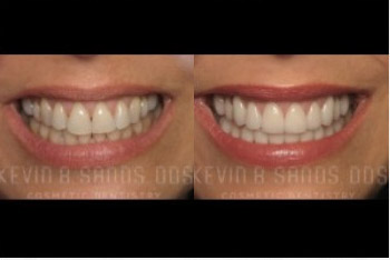 cosmetic-dentistry-beverly-hills-smile-gallery-01