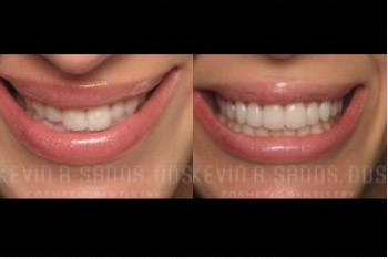 cosmetic-dentistry-beverly-hills-smile-gallery-02