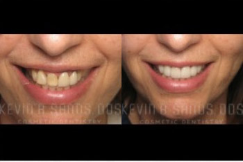 cosmetic-dentistry-beverly-hills-smile-gallery-01